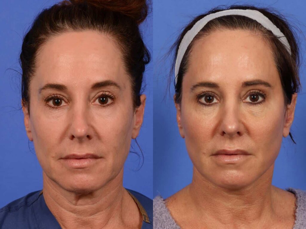 post-facelift-with-submentoplasty-lower-lid-fractional-laser.-FACELIFT-NECKLIFT-AP-FIRST-1