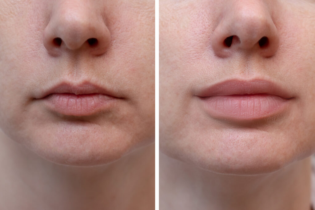Female lips before and after augmentation, the result of using hyaluronic filler.