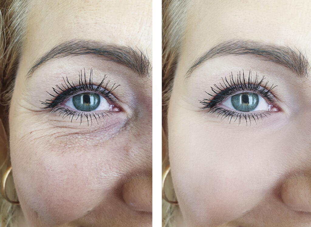 Woman face eyes wrinkles before and after