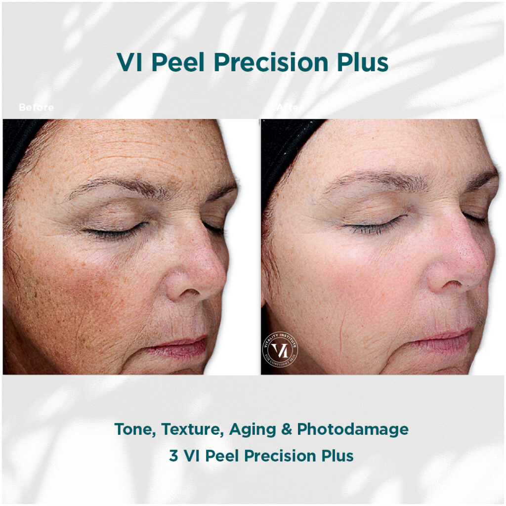 VI Peel Precision Plus